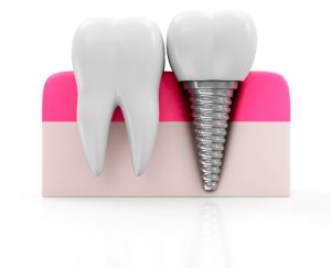 Clinica Dental Bravo - Especialistas en Implantes