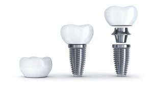Clinica Dental Bravo - Especialistas en Implantes